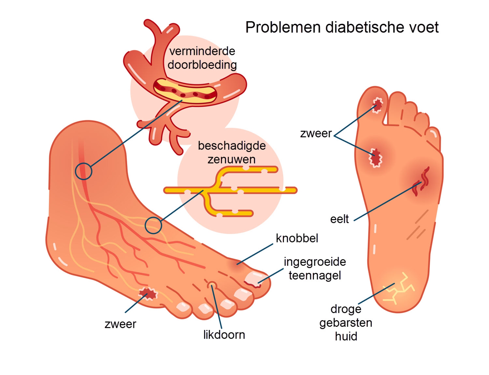 Omgekeerde Vaag ijzer Diabetische voet - Slingeland Ziekenhuis