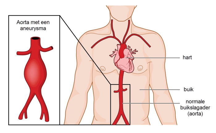 Een aneurysma in de buikslagader ten opzichte van een normale buikslagader.