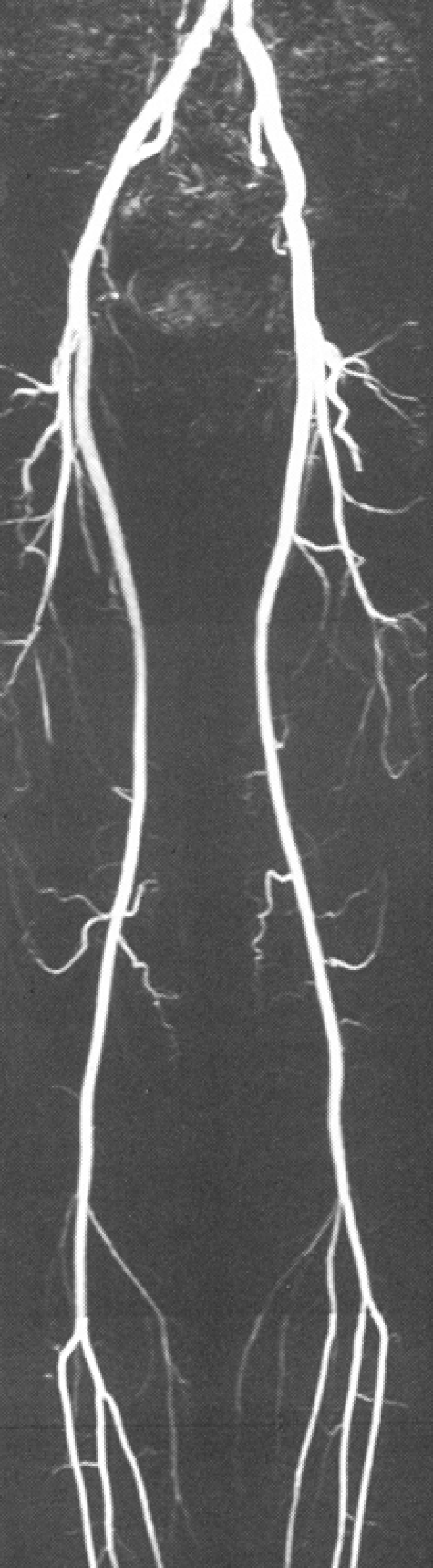 Röntgenbeeld van bloedvaten door middel van angriografie. 