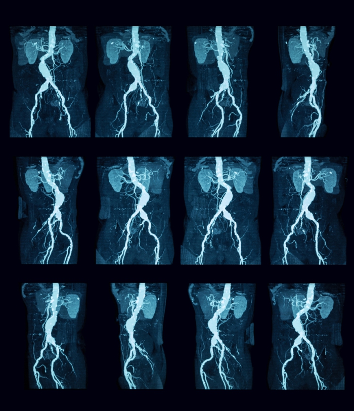 CT Angiography: serie opnamen van de buikaorta.