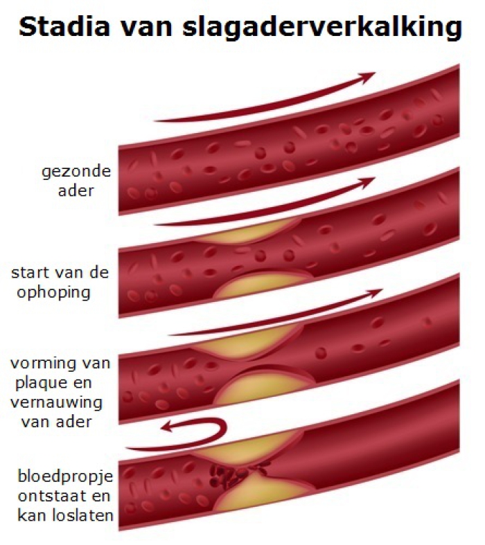 Stadia van slagaderverkalking: van gezonde ader naar start van de ophoping , daarna de vorming van plaque en het ontstaan van een vernauwing en uiteindelijk de vorming van een bloedpropje.